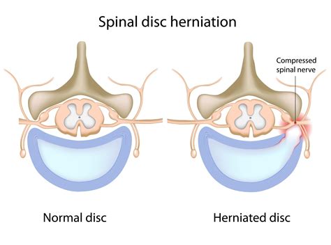 mechanical stimulation of discs